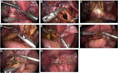 Curative effect and technical key points of laparoscopic surgery for choledochal cysts in children